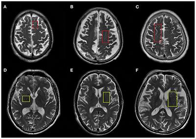 Enlarged perivascular spaces are linked to freezing of gait in Parkinson's disease